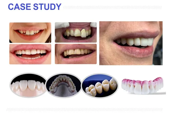 case of 1200 MPA Multilayer Dental Zirconia Block case of 1200 MPA Multilayer Dental Zirconia Block